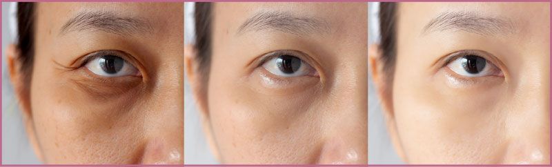 黑眼圈、眼周細紋、眼袋的缺點